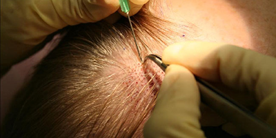 Surgical Method
