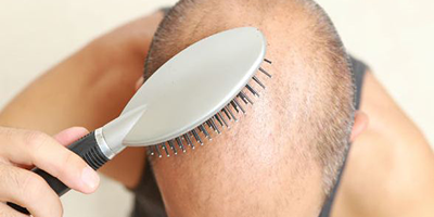 Hair Replacement web links